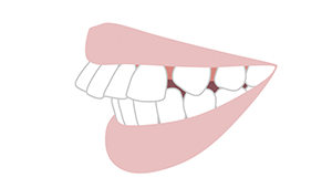 出っ歯(上顎前突)