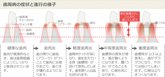 歯周病の症状と進行の様子